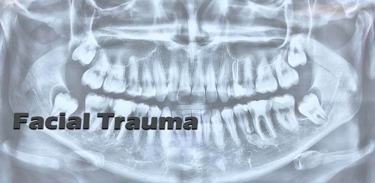 Facial Trauma